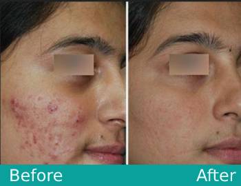 Acne Treatment in Lucknow